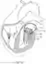 Fig. 91 - METHODS AND DEVICES FOR VENTRICULAR RESHAPING AND HEART VALVE RESHAPING