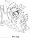 Fig. 92 - METHODS AND DEVICES FOR VENTRICULAR RESHAPING AND HEART VALVE RESHAPING