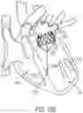 Fig. 93 - METHODS AND DEVICES FOR VENTRICULAR RESHAPING AND HEART VALVE RESHAPING
