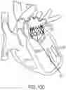 Fig. 94 - METHODS AND DEVICES FOR VENTRICULAR RESHAPING AND HEART VALVE RESHAPING