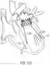Fig. 95 - METHODS AND DEVICES FOR VENTRICULAR RESHAPING AND HEART VALVE RESHAPING