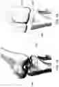 Fig. 02 - Magnetic prosthetic
