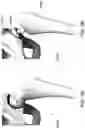 Fig. 03 - Magnetic prosthetic