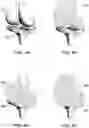 Fig. 05 - Magnetic prosthetic