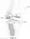 Fig. 12 - Magnetic prosthetic