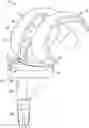 Fig. 01 - Femoral prostheses with upsizing and downsizing capabilities