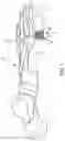 Fig. 02 - Metarsophalangeal joint replacement device and methods