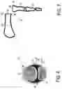 Fig. 06 - Metarsophalangeal joint replacement device and methods