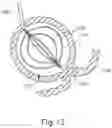 Fig. 17 - Apparatus and method for gastric volume reduction utilizing an expandable member