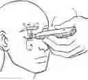Fig. 01 - Devices and methods for treating eyelids