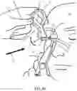 Fig. 10 - Devices and methods for treating eyelids