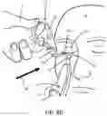 Fig. 11 - Devices and methods for treating eyelids