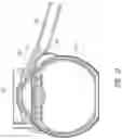 Fig. 10 - Ab externo intraocular shunt placement