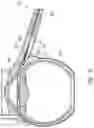 Fig. 12 - Ab externo intraocular shunt placement