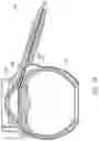 Fig. 15 - Ab externo intraocular shunt placement