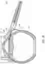 Fig. 16 - Ab externo intraocular shunt placement