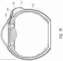 Fig. 17 - Ab externo intraocular shunt placement