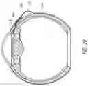 Fig. 18 - Ab externo intraocular shunt placement