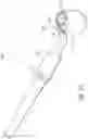 Fig. 23 - Ab externo intraocular shunt placement