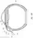 Fig. 29 - Ab externo intraocular shunt placement