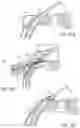 Fig. 33 - Ab externo intraocular shunt placement