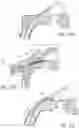 Fig. 34 - Ab externo intraocular shunt placement
