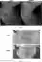 Fig. 17 - Peptide compositions and methods for ameliorating skin laxity and body contour