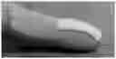 Fig. 01 - Topical pharmaceutical composition containing phenytoin and a (co-) analgesic for the treatment of chronic pain