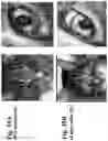 Fig. 36 - Compositions and methods for enhancing innate immunity in a subject for treatment of infections and cancer and other acute and chronic conditions of the eye