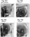 Fig. 37 - Compositions and methods for enhancing innate immunity in a subject for treatment of infections and cancer and other acute and chronic conditions of the eye