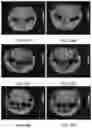 Fig. 20 - MRI IMAGING OF AMYLOID PLAQUE USING LIPOSOMES