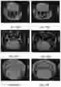 Fig. 22 - MRI IMAGING OF AMYLOID PLAQUE USING LIPOSOMES