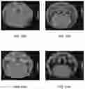 Fig. 23 - MRI IMAGING OF AMYLOID PLAQUE USING LIPOSOMES