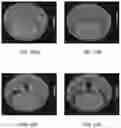 Fig. 24 - MRI IMAGING OF AMYLOID PLAQUE USING LIPOSOMES