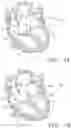 Fig. 02 - Prosthetic tissue valves