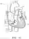 Fig. 03 - Prosthetic tissue valves