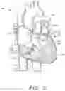 Fig. 12 - Prosthetic tissue valves