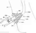Fig. 01 - AORTO OSTIAL FLUID DIRECTING DEVICE