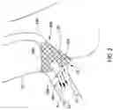 Fig. 04 - AORTO OSTIAL FLUID DIRECTING DEVICE