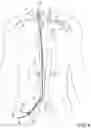 Fig. 05 - Devices for transvascular retrograde access placement