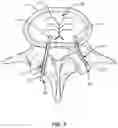 Fig. 04 - Devices for delivering a chemical denervation agent and methods of use