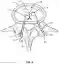Fig. 05 - Devices for delivering a chemical denervation agent and methods of use