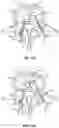 Fig. 13 - Devices for delivering a chemical denervation agent and methods of use