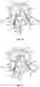 Fig. 18 - Devices for delivering a chemical denervation agent and methods of use