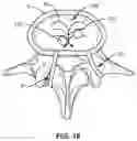 Fig. 19 - Devices for delivering a chemical denervation agent and methods of use