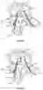Fig. 21 - Devices for delivering a chemical denervation agent and methods of use
