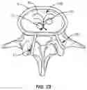 Fig. 22 - Devices for delivering a chemical denervation agent and methods of use