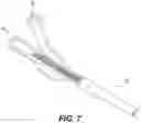 Fig. 08 - DEVICE FOR OCCLUSION ISOLATION AND REMOVAL