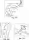 Fig. 63 - Catheter systems and methods for medical procedures using catheters