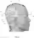 Fig. 05 - Delivering tumor treating fields (TTFields) to the infratentorial brain